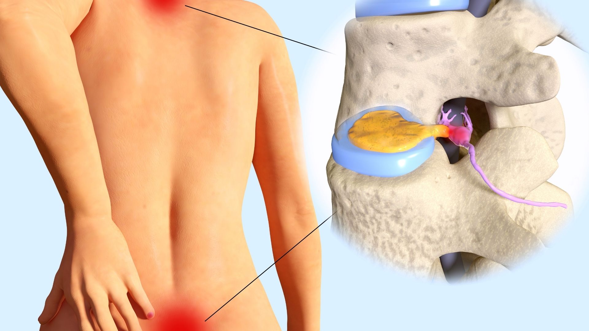 Orientación sobre dolor lumbar, ciática y hernia discal